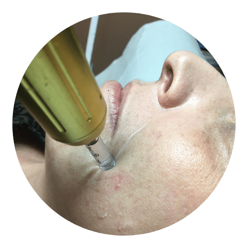 Hyaluronpen Anikbeautymed
