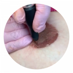 Dermopigmentation aréoles