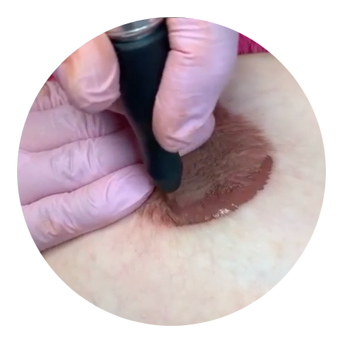 Dermopigmentation aréoles