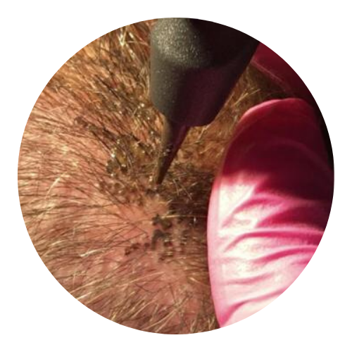 Tricodermopigmentation image