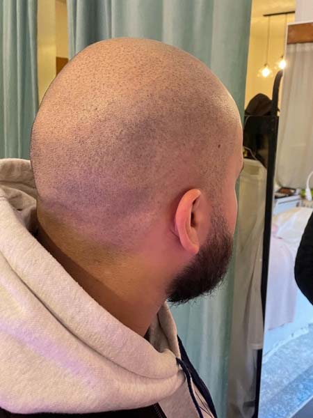 Tattoo anikbeautymed dermapigmentation capillaire 02