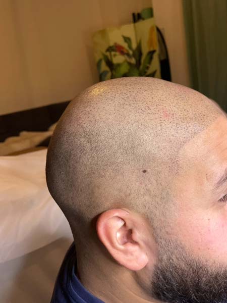 Tattoo anikbeautymed dermapigmentation capillaire 03
