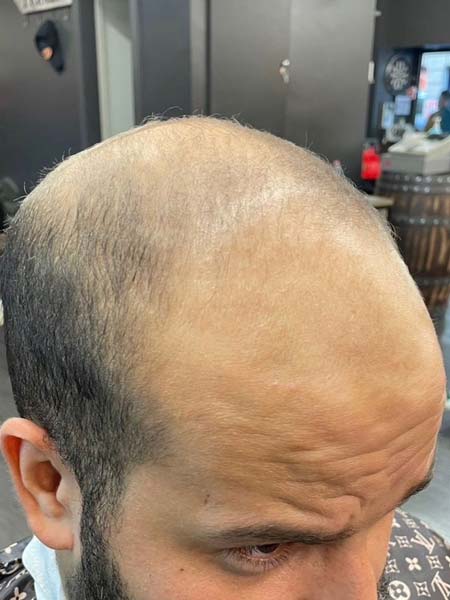 Tattoo anikbeautymed dermapigmentation capillaire 04