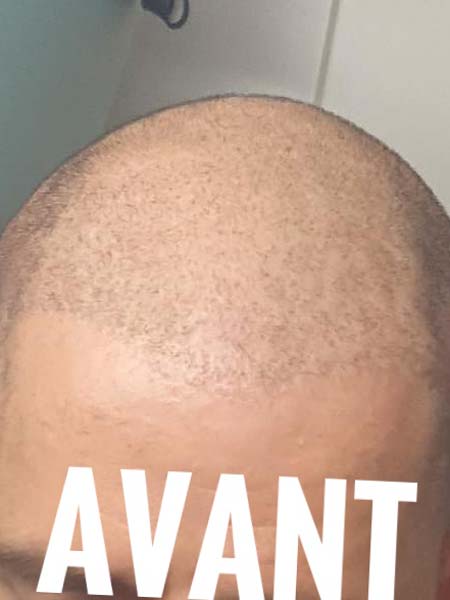Tattoo anikbeautymed dermapigmentation capillaire 05