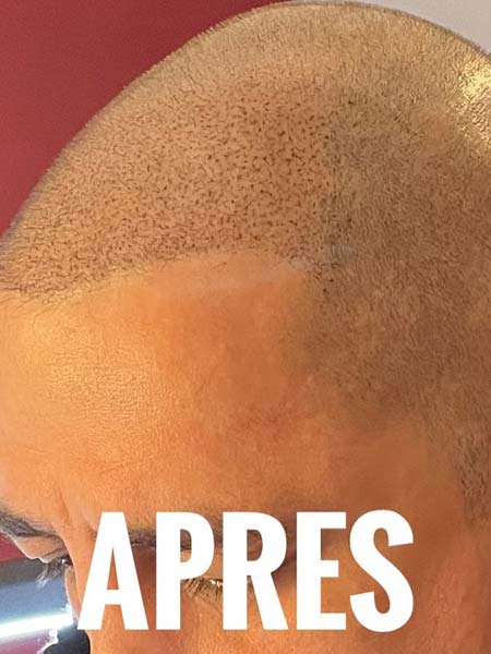 Tattoo anikbeautymed dermapigmentation capillaire 06