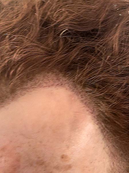Tattoo anikbeautymed dermapigmentation capillaire 07