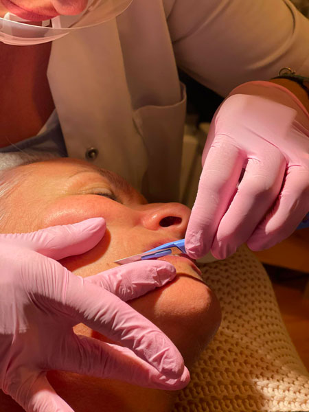 anikbeautymed dermaplaning 03