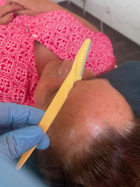 anikbeautymed dermaplaning 06