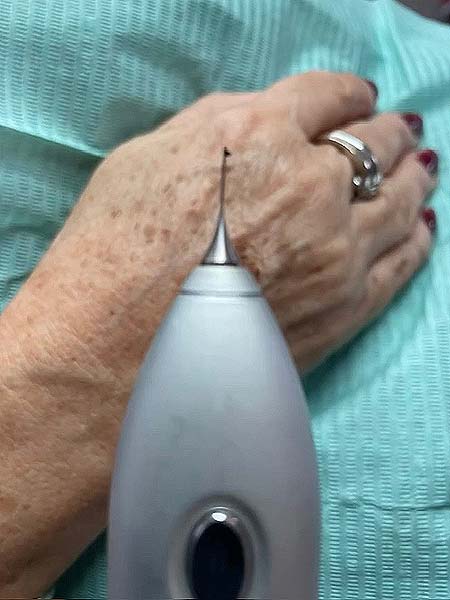 anikbeautymed plasmapen plasma shower 01